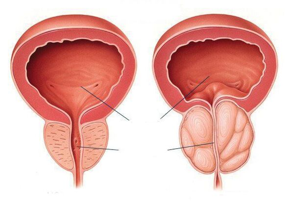Korai ejakuláció és krónikus prostatitis