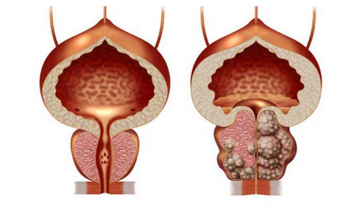 prostatos adenoma